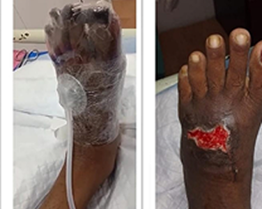 After Negative Pressure Wound Therapy for Diabetic Foot Ulcers